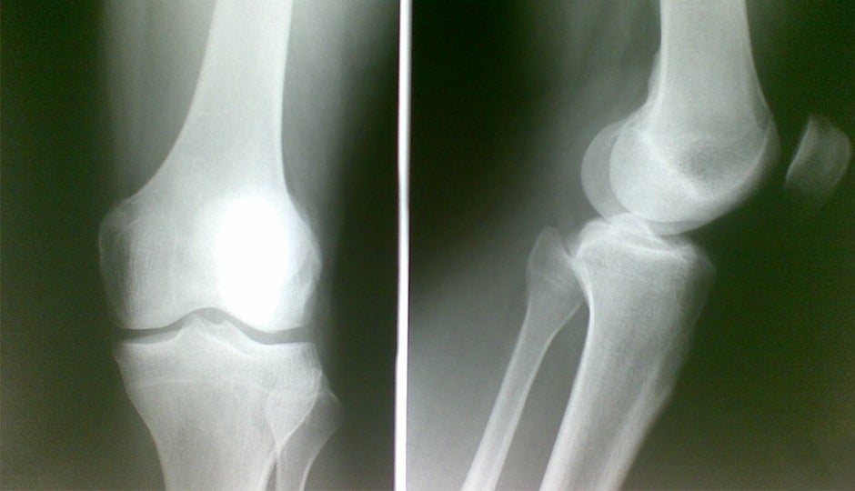 A Climber's Guide to Healthy Knees 5 Tips for Preventing Knee Injuries