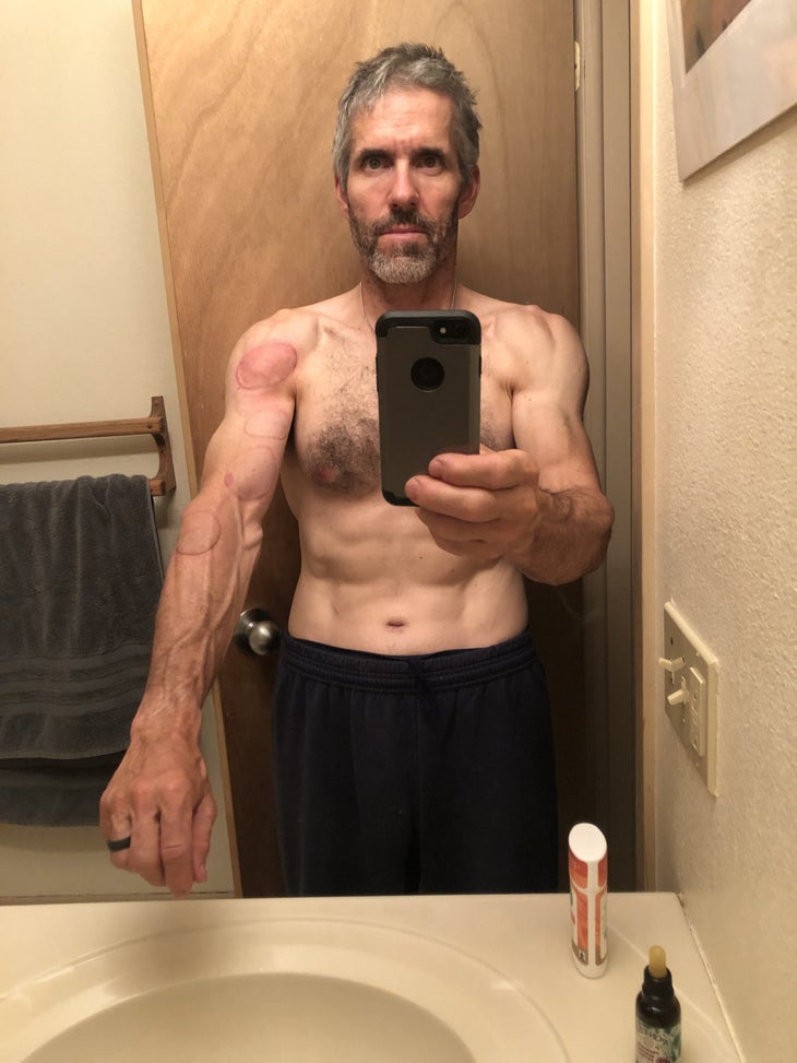 Post-Cupping Session