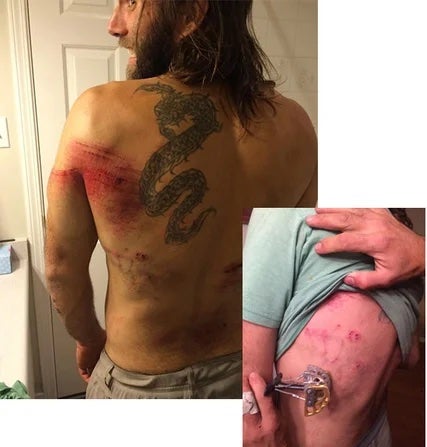 Climber displays bruised and bloodied back after a climbing fall.